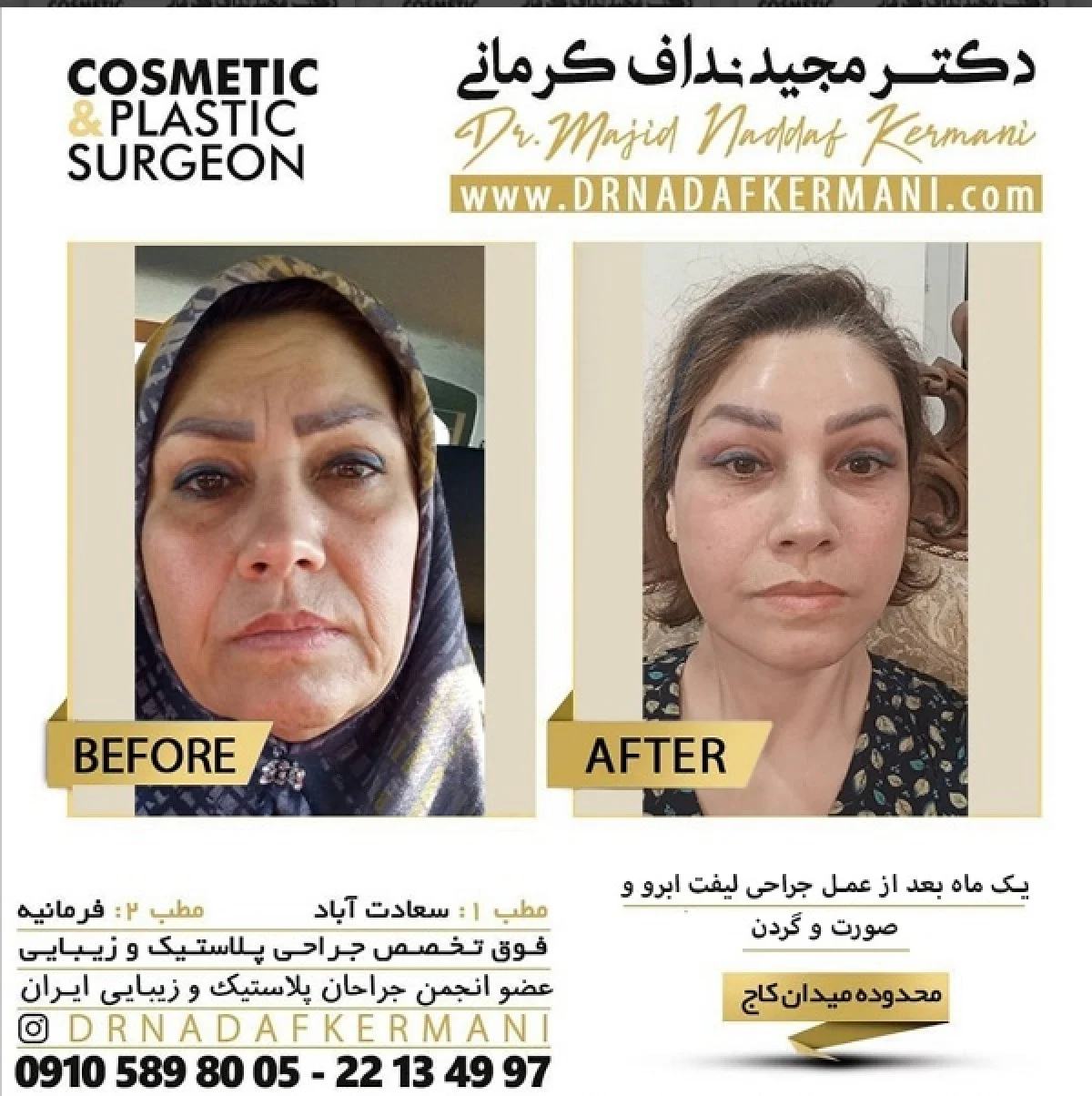 2025-12-04_17-26-47_822192-meylesokhan-ir مزایای لیفت صورت