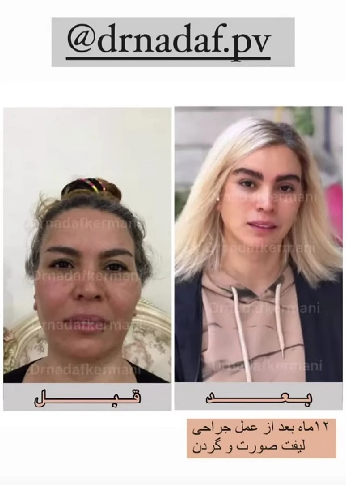 2025-12-04_17-26-48_104636-meylesokhan-ir هزینه لیفت صورت