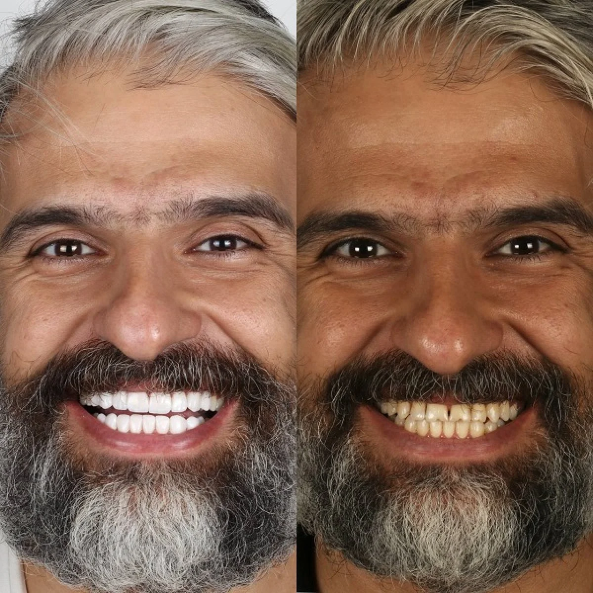 کامپوزیت ونیر چیست و چگونه روی دندان ها اجرا می شود؟