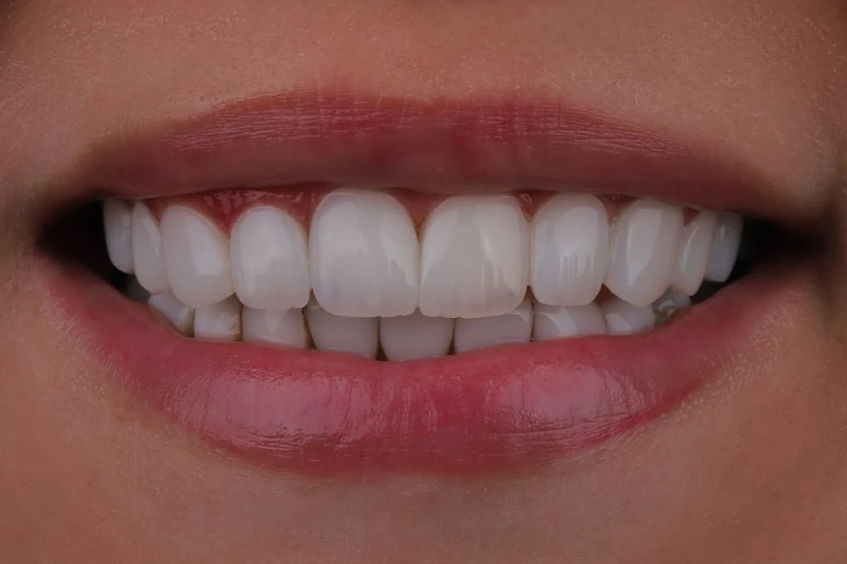 نحوه انتخاب بهترین دندانپزشک زیبایی کامپوزیت ونیر