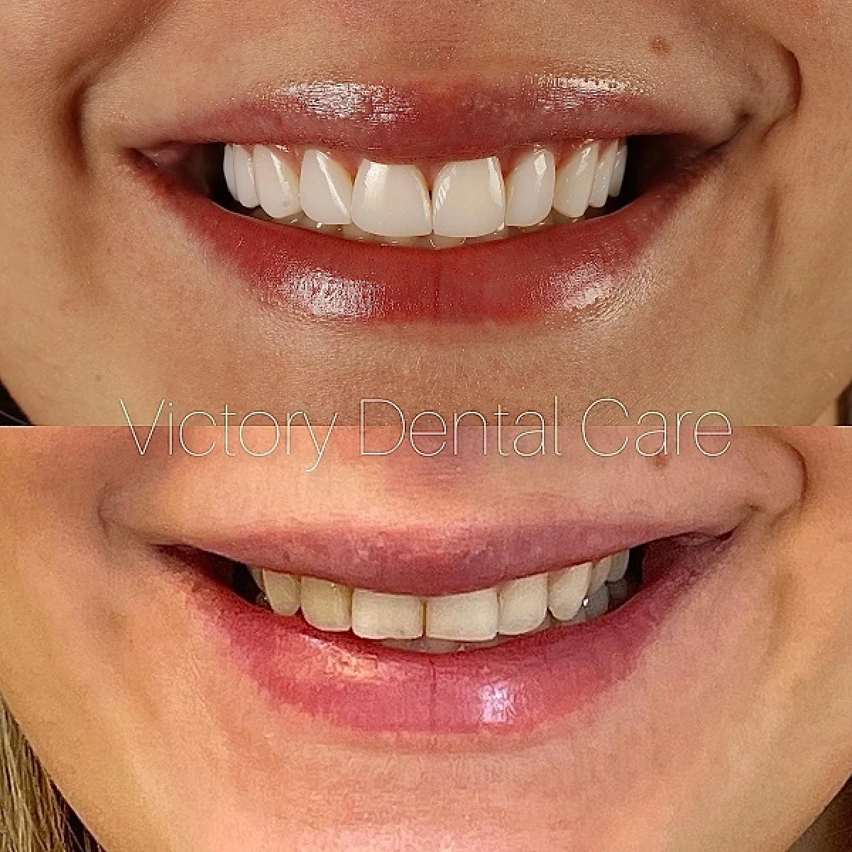 نحوه انتخاب بهترین دندانپزشک زیبایی کامپوزیت ونیر